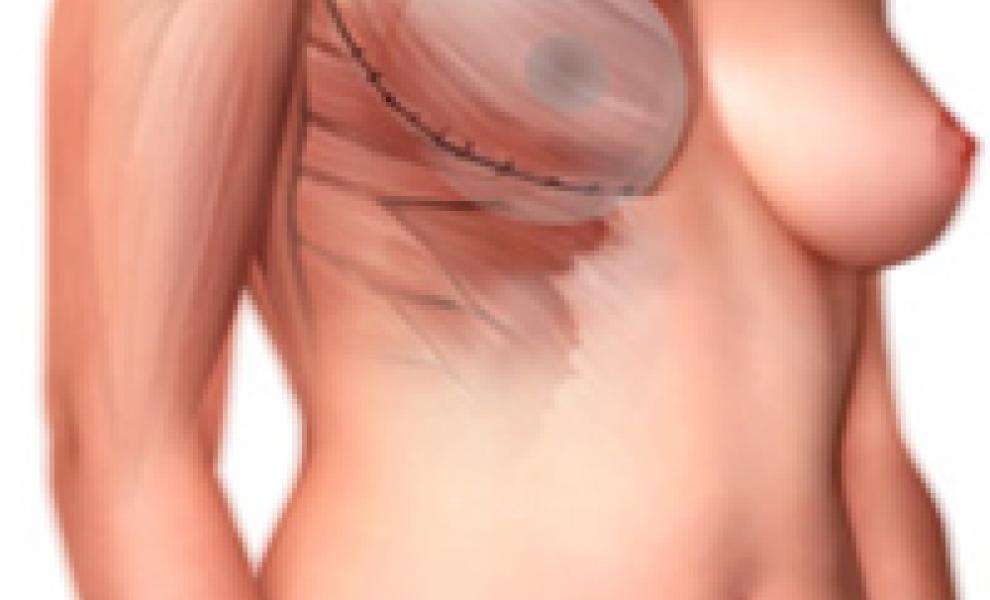 Medical drawing of Two stage expander/implant reconstruction showing stitches in the muscular layer under the breast