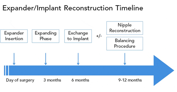 A visual representation of the timeline for expander/implant reconstruction timeline. Timeline begins at Day of Surgery, expander insertion, then 3 months explaining phase, then 6 months exchange to implant, then nine to 12 months plus or minus nipple reconstruction and balancing procedure
