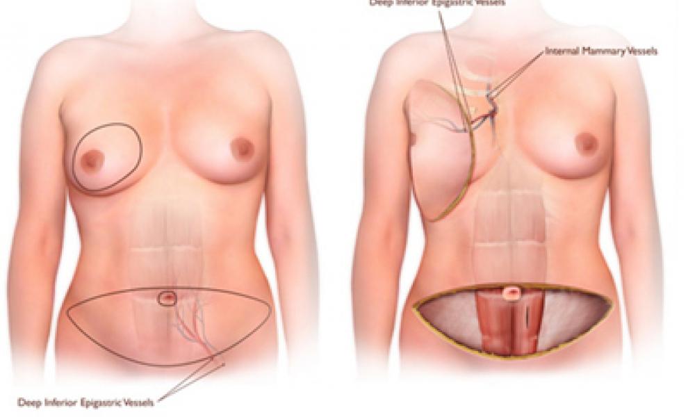 Medical drawing of Free Flap (DIEP or other) showing a before and after image of a flap from the bottom abdomen being moved to the brest muscle